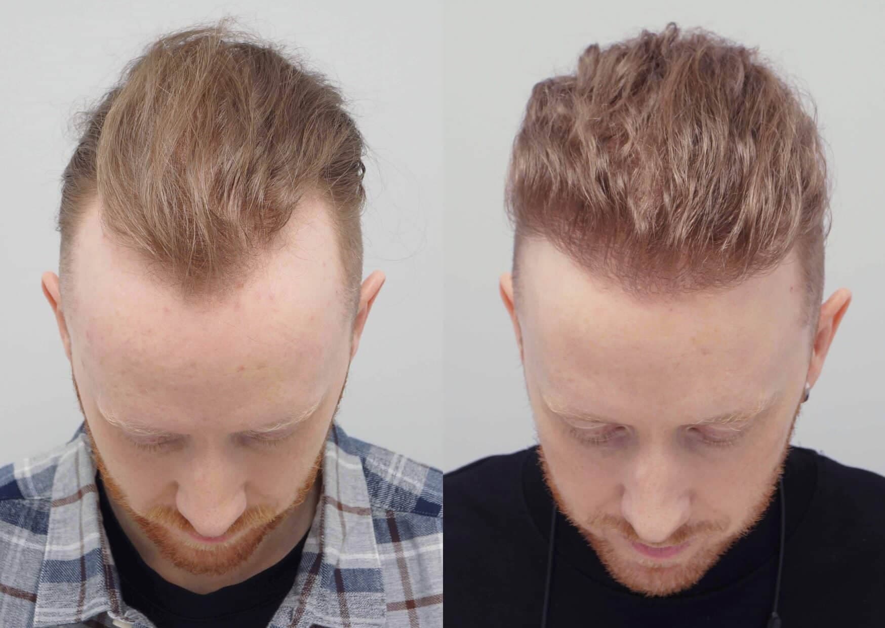 Hair Transplant UK – What to Expect During the Procedure