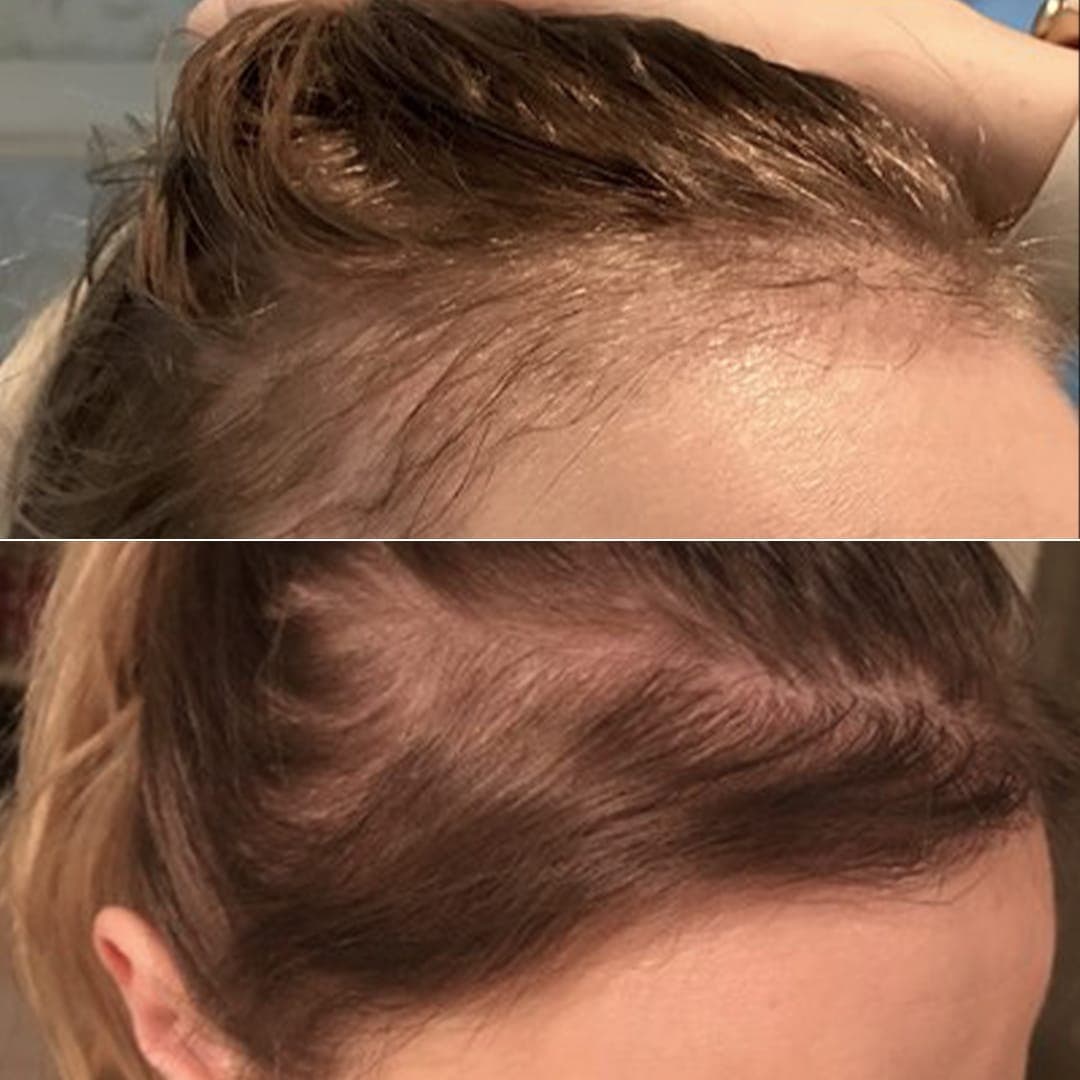 Hair Transplant London – The Science Behind Your New Look