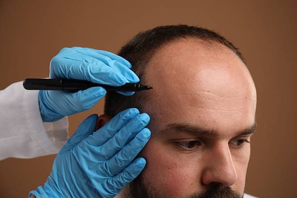 How Much Does Hair Transplant Cost and What Is Included?