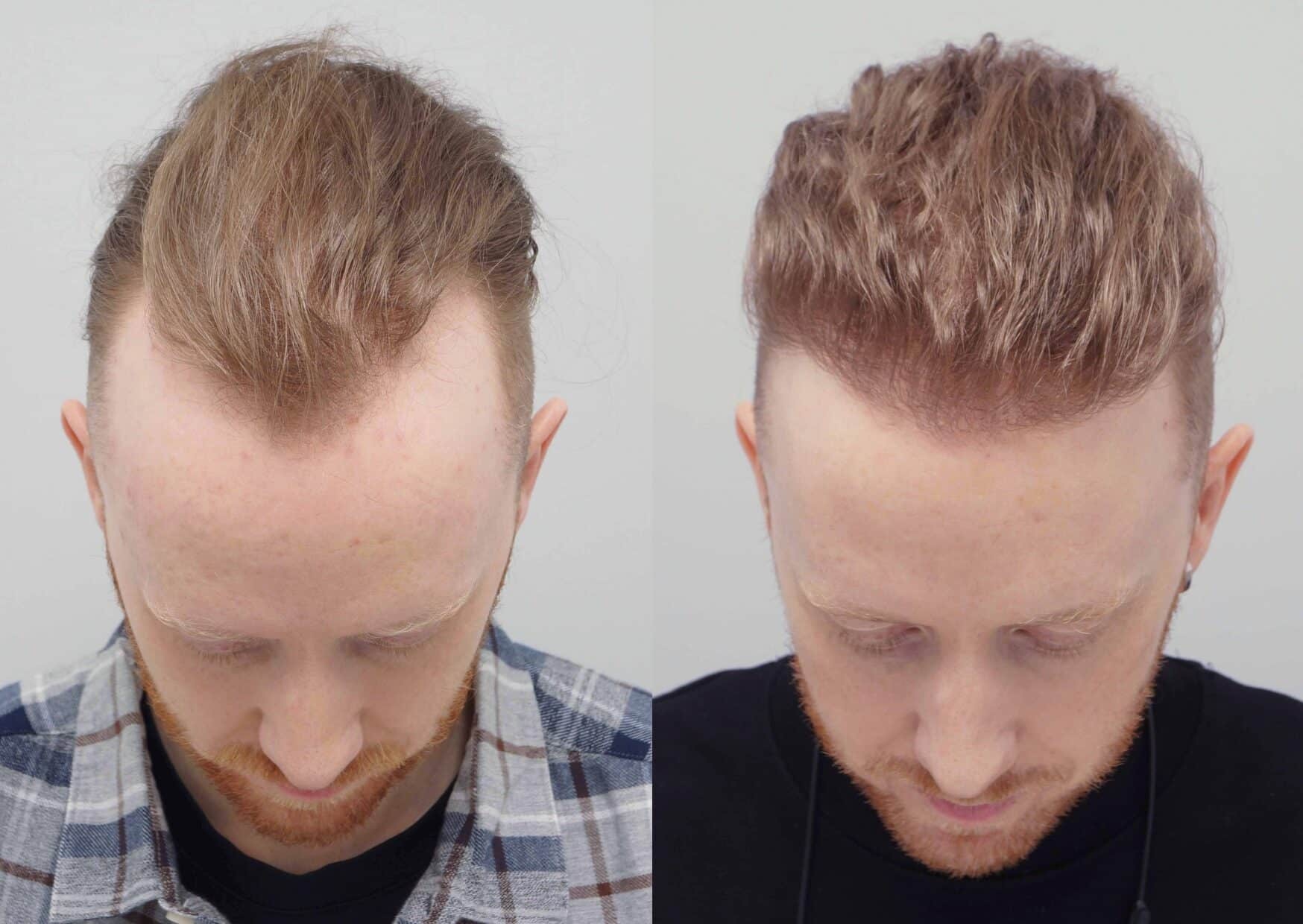 Hair Transplant UK – What to Expect During the Procedure
